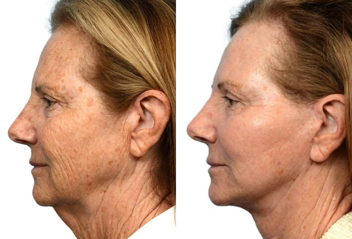 Deep Plane Facelift