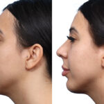 facial-implants-new-jersey-ba-0-2