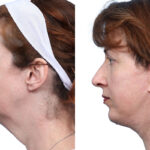 facial-implants-new-jersey-ba-1-2