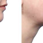 facial-implants-new-jersey-ba-4-2