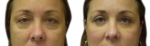 Blepharoplasty Before & After Gallery - Patient 134580