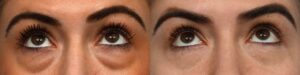 Blepharoplasty Before & After Gallery - Patient 198265 - Image 2