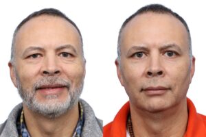 Blepharoplasty Before & After Gallery - Patient 286620