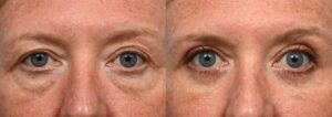 Blepharoplasty Before & After Gallery - Patient 294176