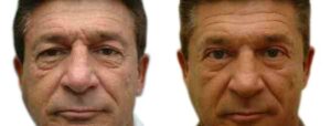 Blepharoplasty Before & After Gallery - Patient 330671