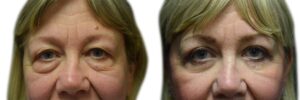 Blepharoplasty Before & After Gallery - Patient 426311