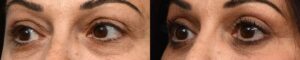 Blepharoplasty Before & After Gallery - Patient 655461 - Image 3