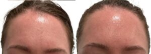 Botox Before & After Gallery - Patient 320446