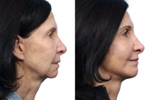 Chin Augmentation Before & After Gallery - Patient 231859