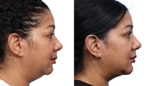 Chin Augmentation Before & After Gallery - Patient 368933
