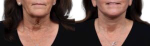 CO2 Laser Before & After Gallery - Patient 384191