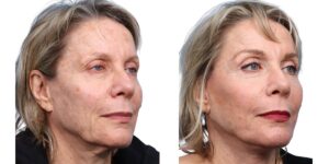 Deep Plane Facelift Before & After Gallery - Patient 103752 - Image 2
