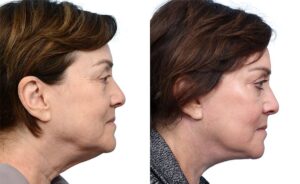 Deep Plane Facelift Before & After Gallery - Patient 164807