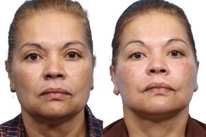 Deep Plane Facelift Before & After Gallery - Patient 194152