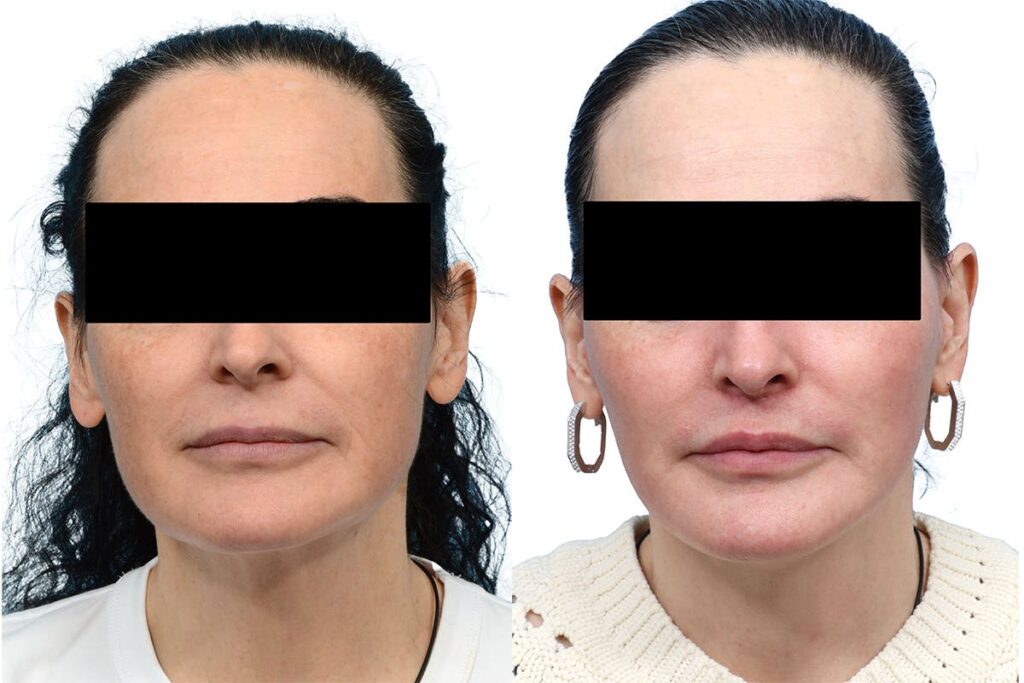 Deep Plane Facelift Before & After Gallery - Patient 233555 - Image 1