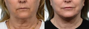 Deep Plane Facelift Before & After Gallery - Patient 315819