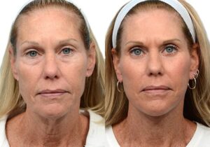 Deep Plane Facelift Before & After Gallery - Patient 318945