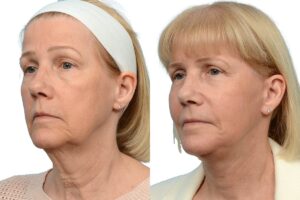 Deep Plane Facelift Before & After Gallery - Patient 333849 - Image 2