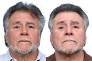Deep Plane Facelift Before & After Gallery - Patient 408034