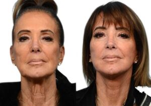 Deep Plane Facelift Before & After Gallery - Patient 409326