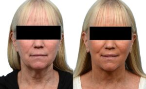 Deep Plane Facelift Before & After Gallery - Patient 660261