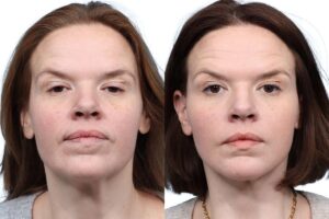 Deep Plane Facelift Before & After Gallery - Patient 686427