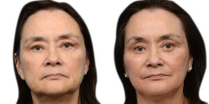 Deep Plane Facelift Before & After Gallery - Patient 688756