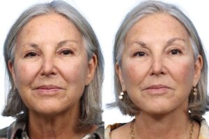 Deep Plane Facelift Before & After Gallery - Patient 785463