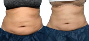 EMSculpt Before & After Gallery - Patient 163474