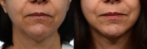Facelift Before & After Gallery - Patient 101438