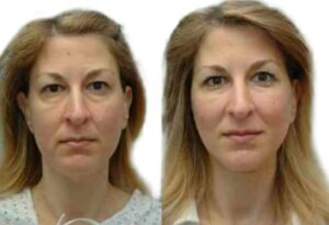 Facelift Before & After Gallery - Patient 101917