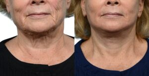 Facelift Before & After Gallery - Patient 129558