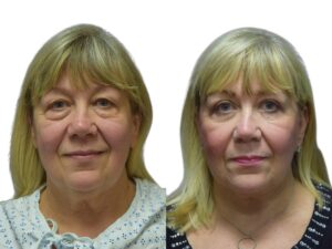 Facelift Before & After Gallery - Patient 210207