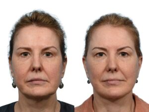 Facelift Before & After Gallery - Patient 212905