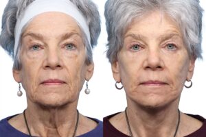 Facelift Before & After Gallery - Patient 225528