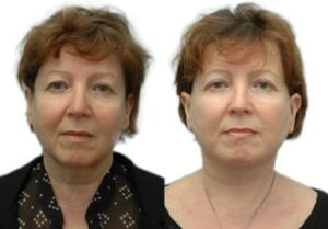 Facelift Before & After Gallery - Patient 257286