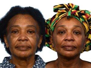 Facelift Before & After Gallery - Patient 313848