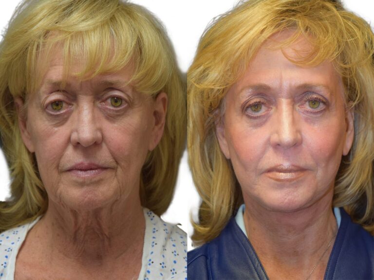 Facelift Patient 574183 Before