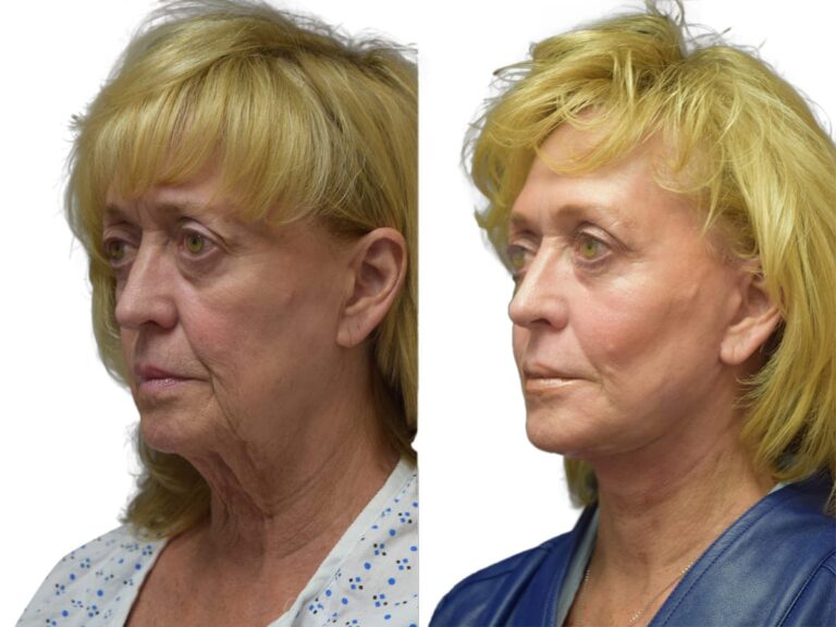 Facelift Patient 574183 After