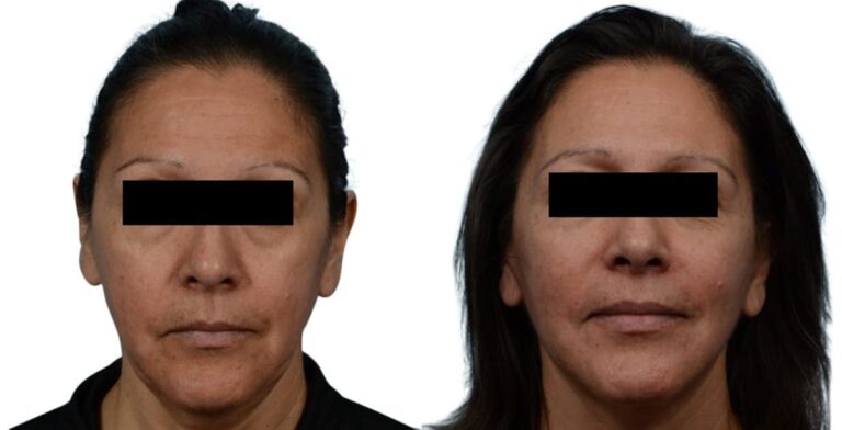 Facelift Patient 628128 Before