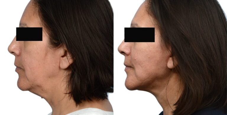 Facelift Patient 628128 After