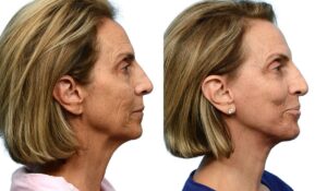 Facelift Before & After Gallery - Patient 659587
