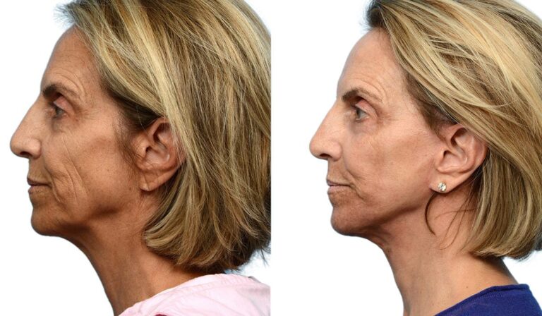 Facelift Patient 659587 After