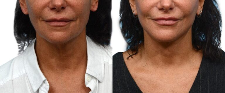 Facelift Patient 742453 Before