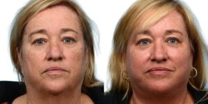 Facelift Before & After Gallery - Patient 779916