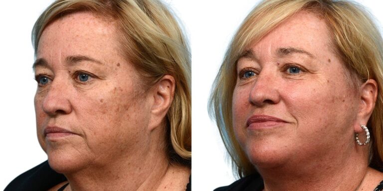 Facelift Patient 779916 After