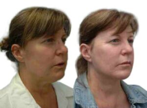 Facelift Before & After Gallery - Patient 843586