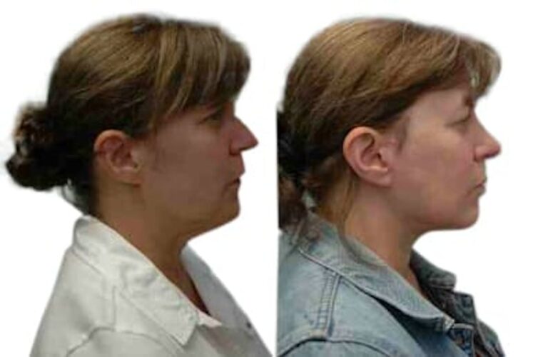 Facelift Patient 843586 After