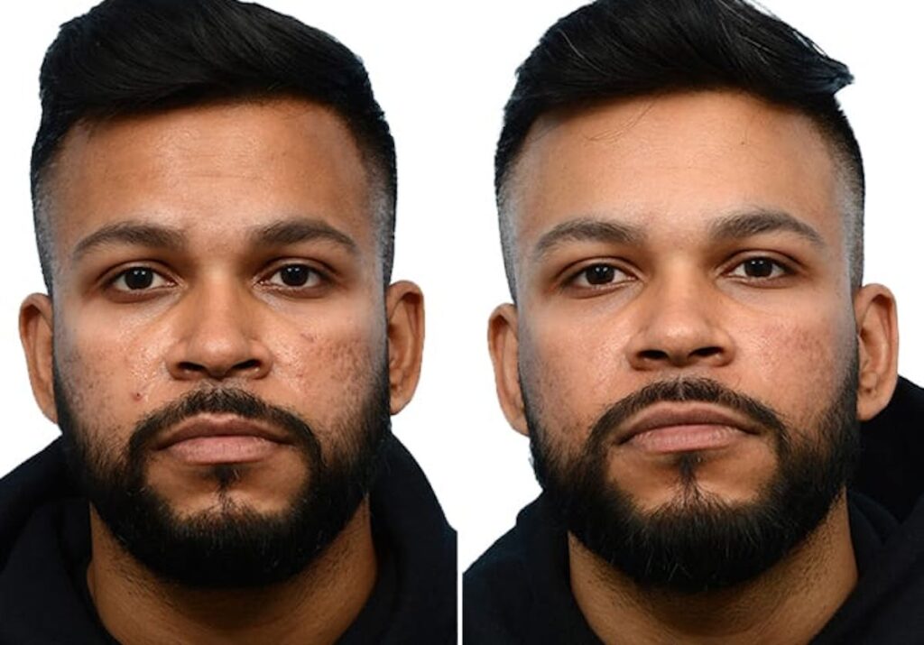 Morpheus8 Before & After Gallery - Patient 109010 - Image 1