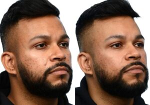 Morpheus8 Before & After Gallery - Patient 109010 - Image 2